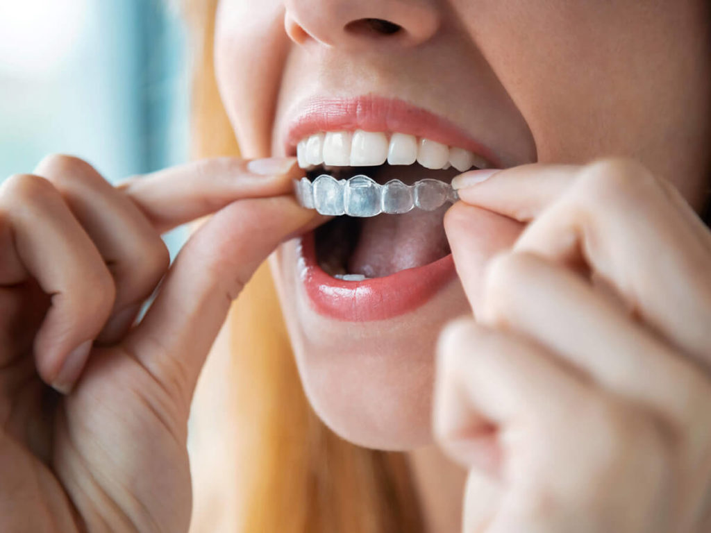 Woman fitting Invisalign into mouth