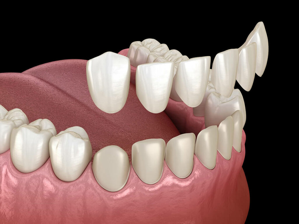 Dental Veneers application mockup
