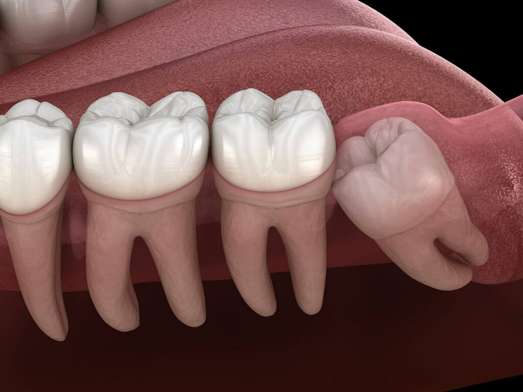 Improperly growing wisdom tooth mockup