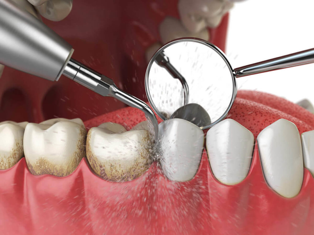 Teeth cleaning mockup with water pick cleaning between teeth