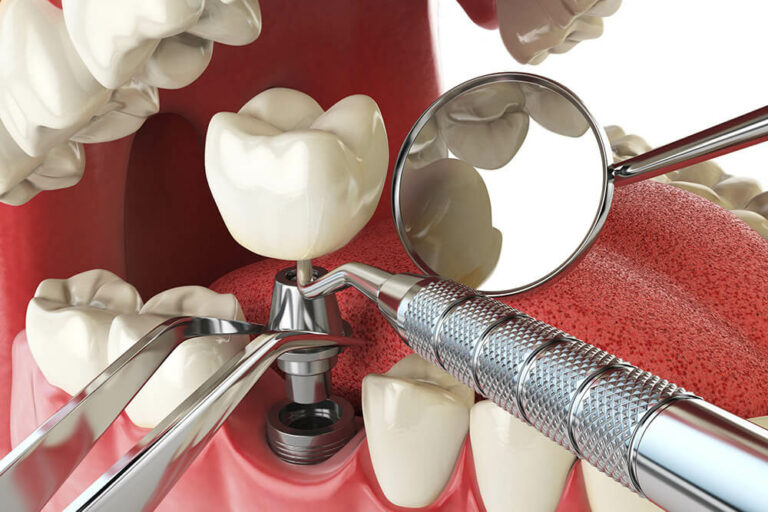 dental implant procedure mockup
