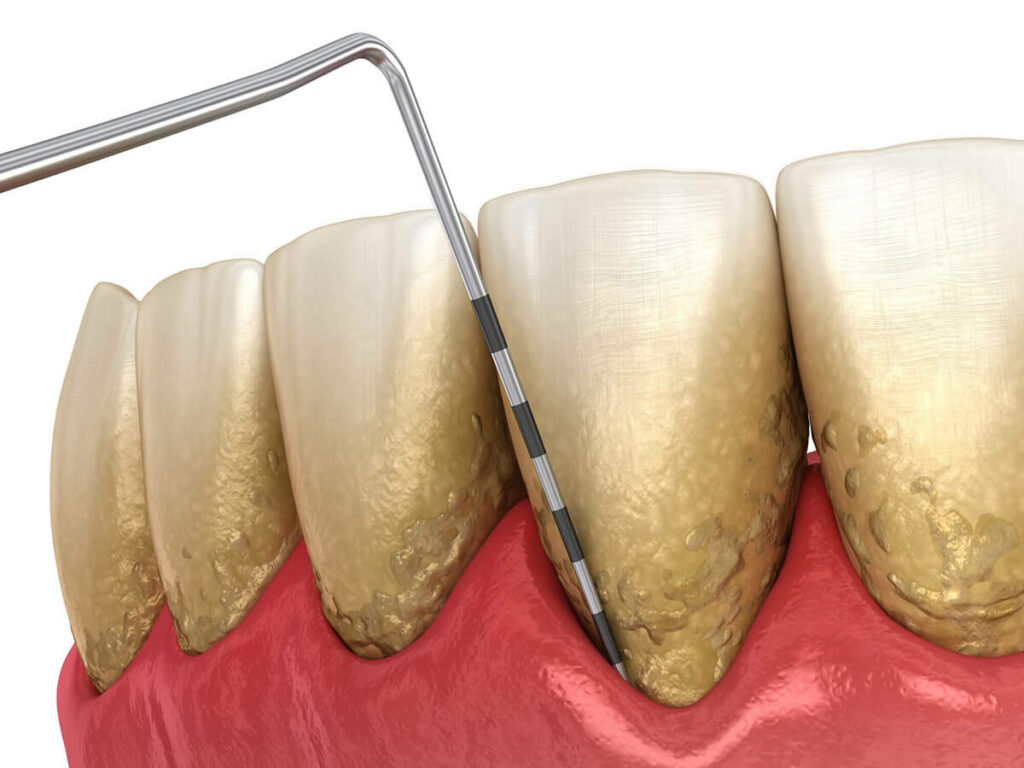 Gum disease mockup showing tender gums and plaque covered teeth