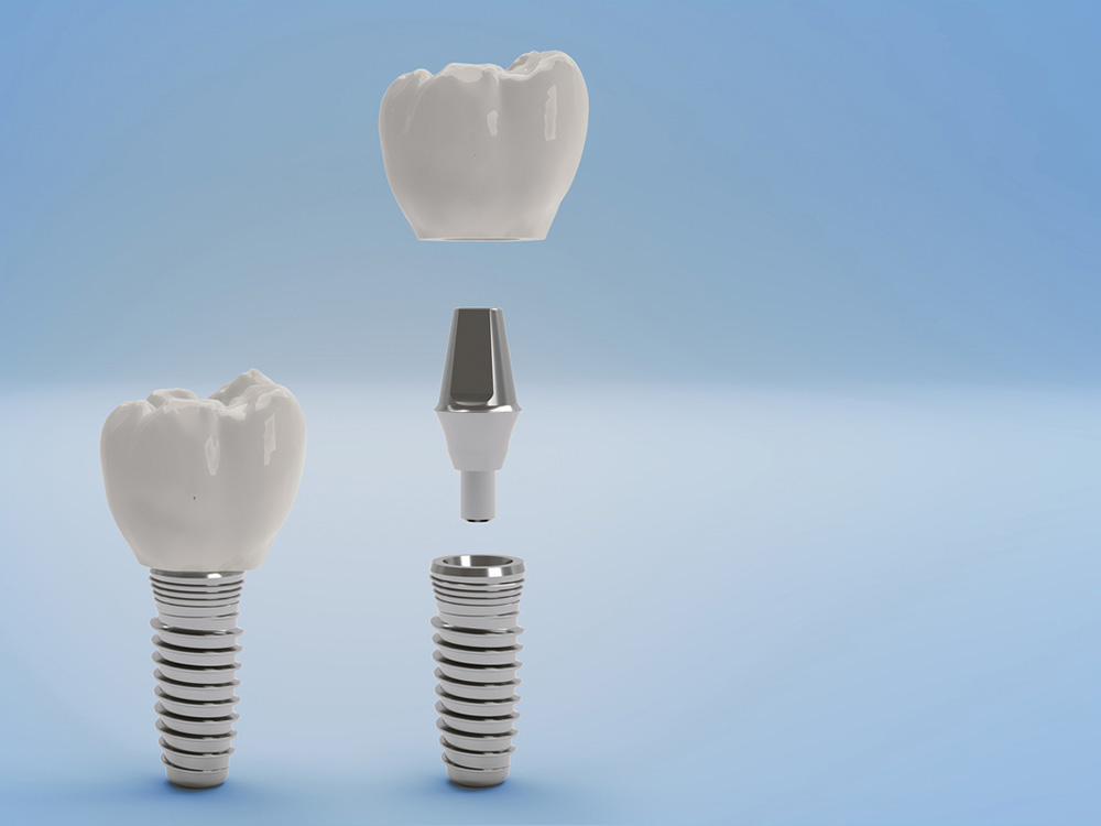 Dental Implant Post Abutement and Crown